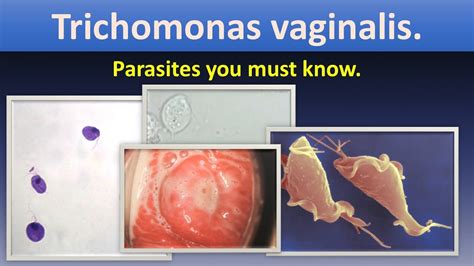 Trichomonas Vaginalis Infection Transmission Symptoms Diagnosis The Best Porn Website