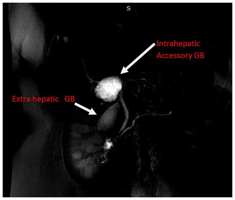 Intrahepatic Gallbladder Duplication Mimicking A Hepatic Cyst A Case