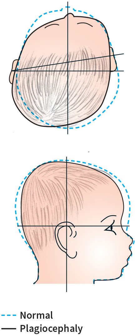 Flat Head Syndrome How To Mend It