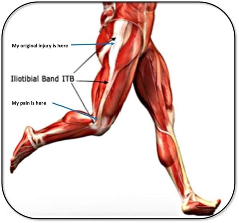 Iliotibial Band Friction Syndrome Itbfs The Physio Approach Mgs