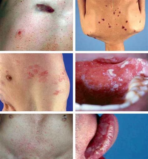 Figure Hivaids Associated Diseases A 20 To 50 Of Patients With An