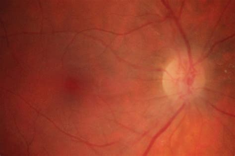 Retinal Ischemia As The First Manifestation Of Antiphospholipid