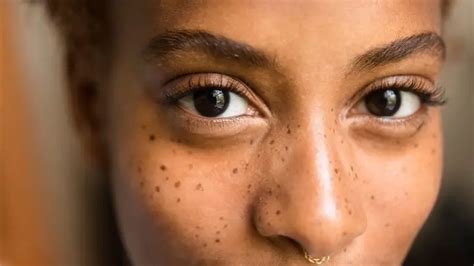 Mole Or Blackhead Heres How To Tell The Difference Africana Fashion