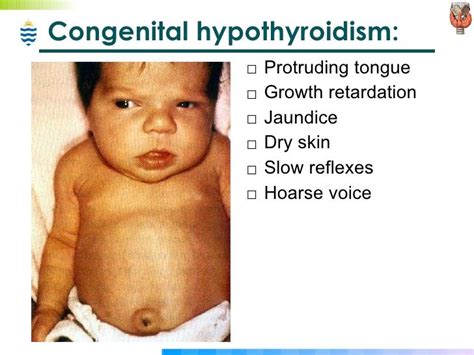 Congenital Hypothyroidism Thyroid Symptoms Learn More By Visiting The