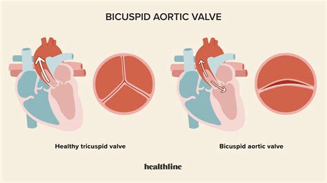 Bicuspid Aortic Valve Diagnosis Treatment And Outlook