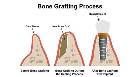 Bones of the lower extremity. Bone Grafting for Dental Implants