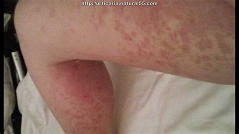 Hives Allergic Reaction Flyfasr