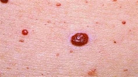 Red Moles On Skin Causes And Treatment Options