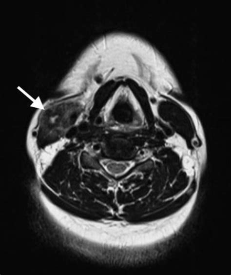 Solitary Cysticercosis Of The Sternocleidomastoid Muscle Bmj Case Reports
