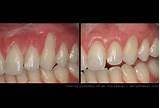 Gum Line Cavity Treatment Pictures