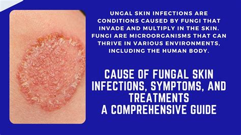 Cause Of Fungal Skin Infections Symptoms And Treatments A