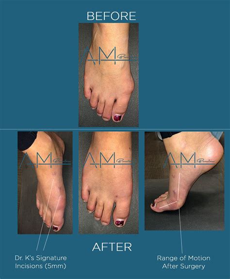 Bunion Surgery Before And After Hode Geek