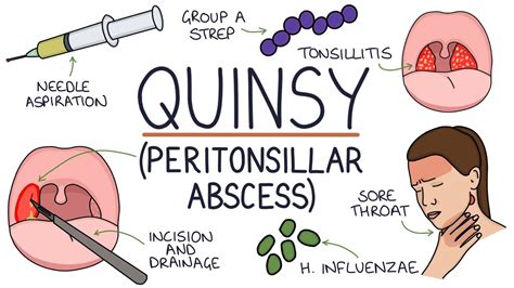 Understanding Quinsy Peritonsillar Abscess Youtube