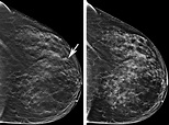 3D Mammography Creates More Precise Images To Detect Breast Cancer ...