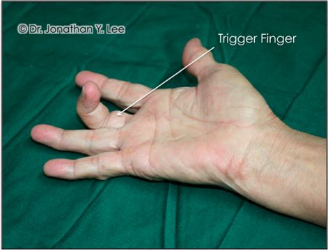 Tendonitis Of Elbow Hands And Wrist Dr Jonathan Lee Yi Liang