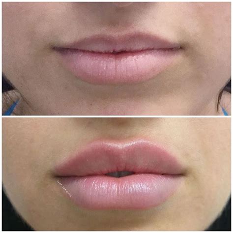 1ml Of Lip Filler 4 Weeks Follow Up Repost From Last Year Thank You