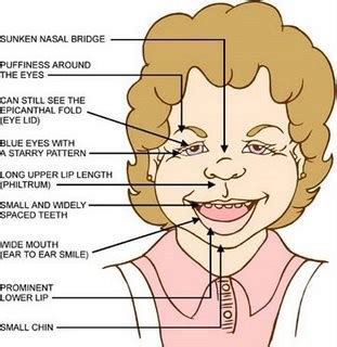 Characteristics An Educator S Approach To Williams Syndrome