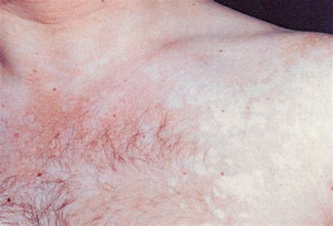 Pityriasis Versicolor Alba Tinea Versicolor Or Pityriasis Alba In