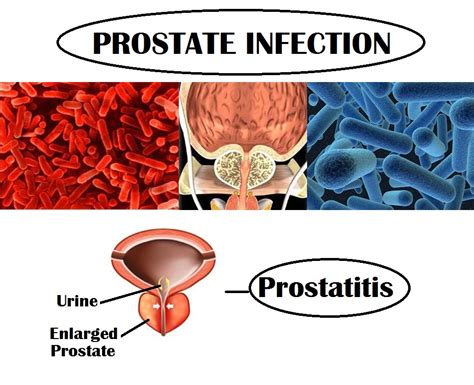 Everything You Need To Know About Prostate Gland