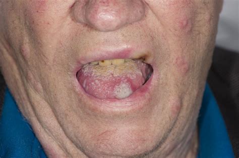 Oral Sweets Syndrome Occurring In Ulcerative Colitis Nestor And