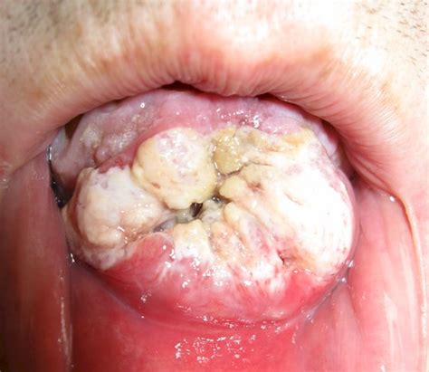 Cancer classification based on histological type. Mouth Cancer Pictures