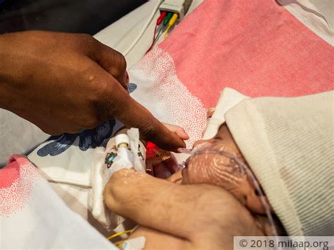 Only An Urgent Surgery Can Cure This 11 Day Old Baby Who Cries Out In