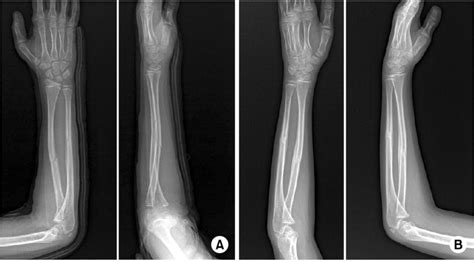 A Initial Posterioranterior Pa And Lateral Radiograph Of An