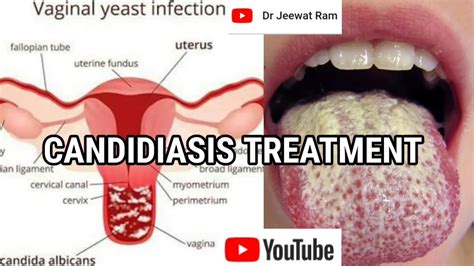 Oral And Vaginal Candidiasis Treatment And Management Youtube