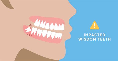 How Long Does It Take To Heal After Wisdom Teeth Removal Aaoms