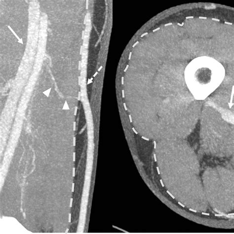 Normal Ct Venography Of The Lower Extremities The Venous System Of The