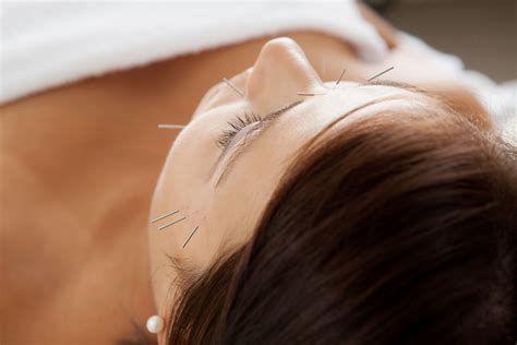facial acupuncture hammersmith west london cosmetic acupuncture w4 w12 w6
