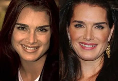 Brooke Shields Plastic Surgery Before And After Botox Injections Celebie
