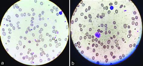 Peripheral Blood Smear Leishman Stain ×100 Showing A Download