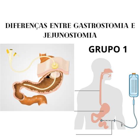 Diferen As Entre Gastrostomia E Jejunostomia Podcast On Spotify
