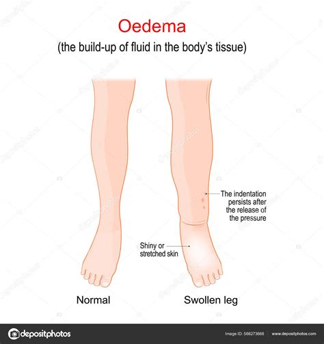 Edema Swollen Ankles Feet Legs Oedema Build Fluid Bodys Tissue Vector