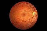 Retina at Piedmont Eye Center
