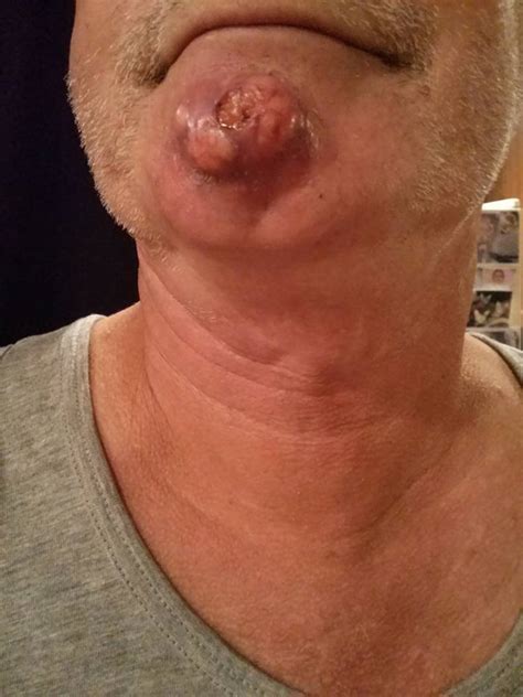 It may also damage melanin, resulting in premature greying. Bobby Shaves For Surgery - KillTheCan.org