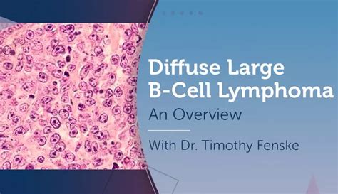 Diffuse Large B Cell Lymphoma An Overview Mylymphomateam