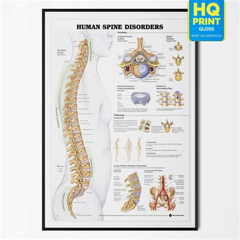 Human Spine Anatomy Column Disorder Chart Biology Science Poster