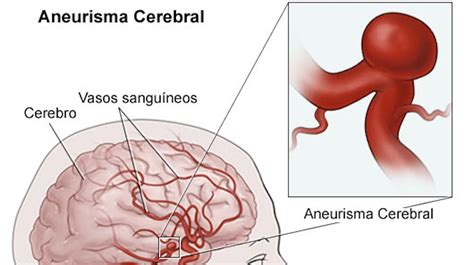 respostas para perceber o que é um aneurisma cerebral como se trata e quais as consequências