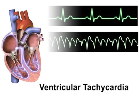 Tachycardia Fast Heartbeat Symptoms Diagnostics Causes Treatment