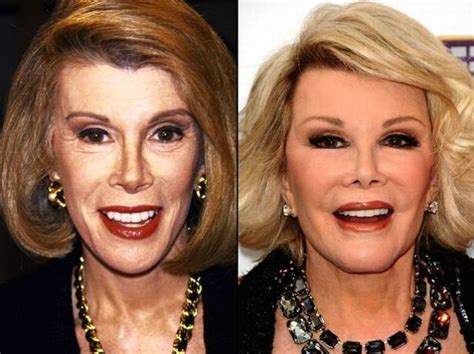 Celebrities Before And After A Plastic Surgery Pics