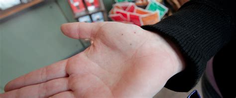 Skin Cancer Moles On Hand