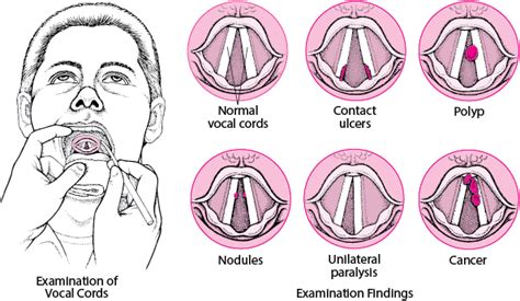 Vocal Cord Polyps Nodules And Granulomas Ear Nose And Throat