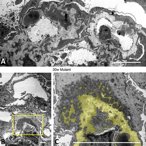 Diffuse Podocyte Effacement Was Associated With Deep Cell Infolding