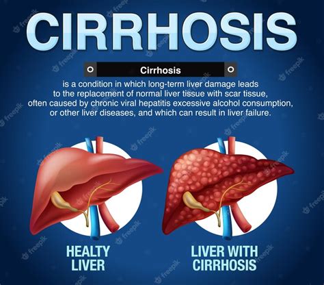 Free Vector Cirrhosis Of The Liver Infographic