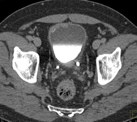 Transitional Cell Carcinoma Of The Bladder Genitourinary Case Studies