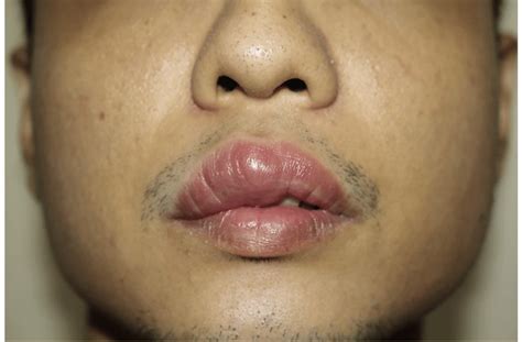 At 3 Months Of Follow Up The Resolution Of The Left Upper Lip Swelling