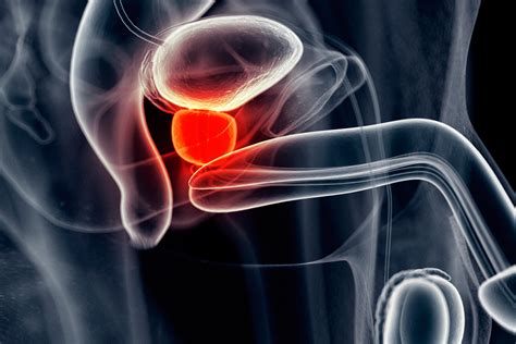 Câncer de próstata as novidades que levam à cura da doença VEJA