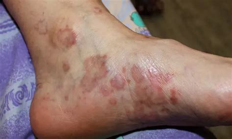 Lichen Planus Symptoms Causes Diagnosis And Treatment